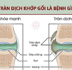 Cách chữa tràn dịch khớp gối bằng phương pháp Đông Y